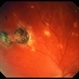 Multifocal Choroiditis & Panuveitis Syndrome